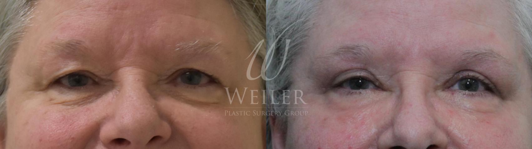 Before & After Eyelid Surgery Case 316 View #1 View in Baton Rouge, Louisiana