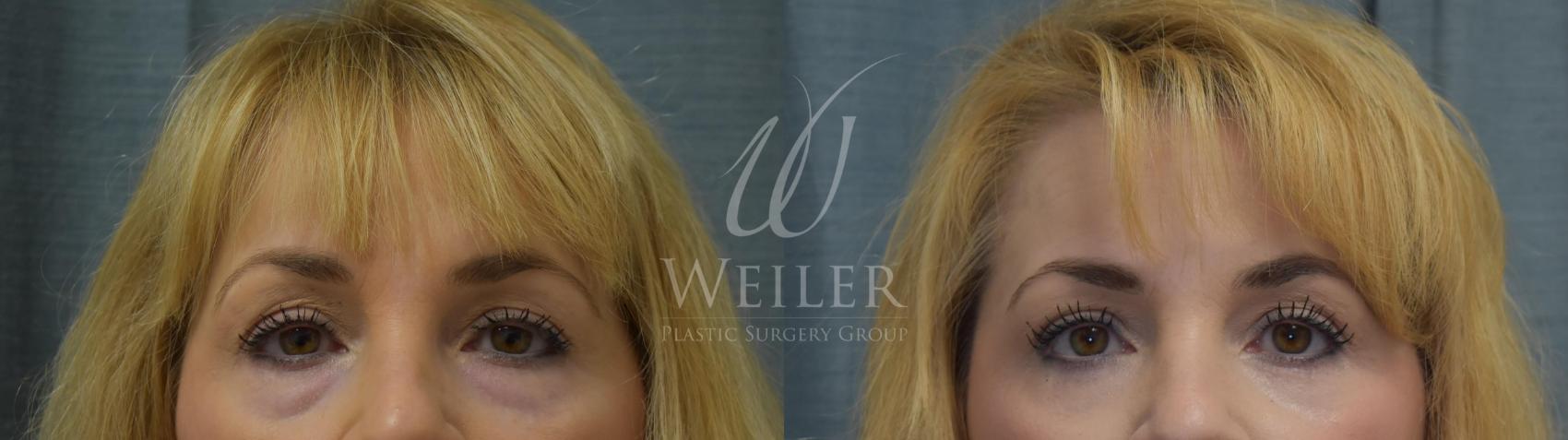 Before & After Eyelid Surgery Case 376 View #1 View in Baton Rouge, Louisiana