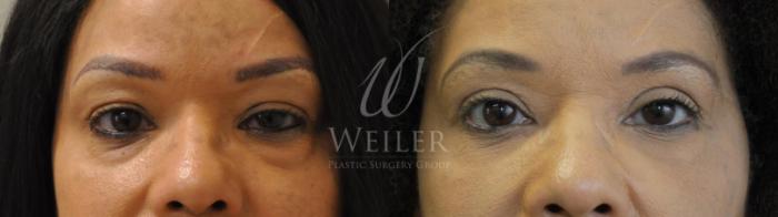 Before & After Eyelid Surgery Case 443 View #1 View in Baton Rouge, New Orleans, & Lafayette, Louisiana