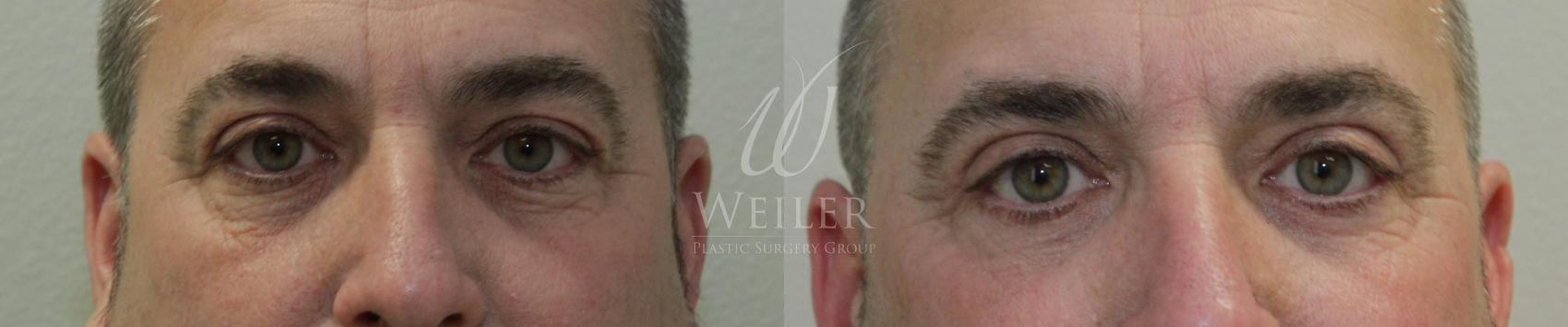 Before & After Eyelid Surgery Case 444 View #1 View in Baton Rouge, New Orleans, & Lafayette, Louisiana