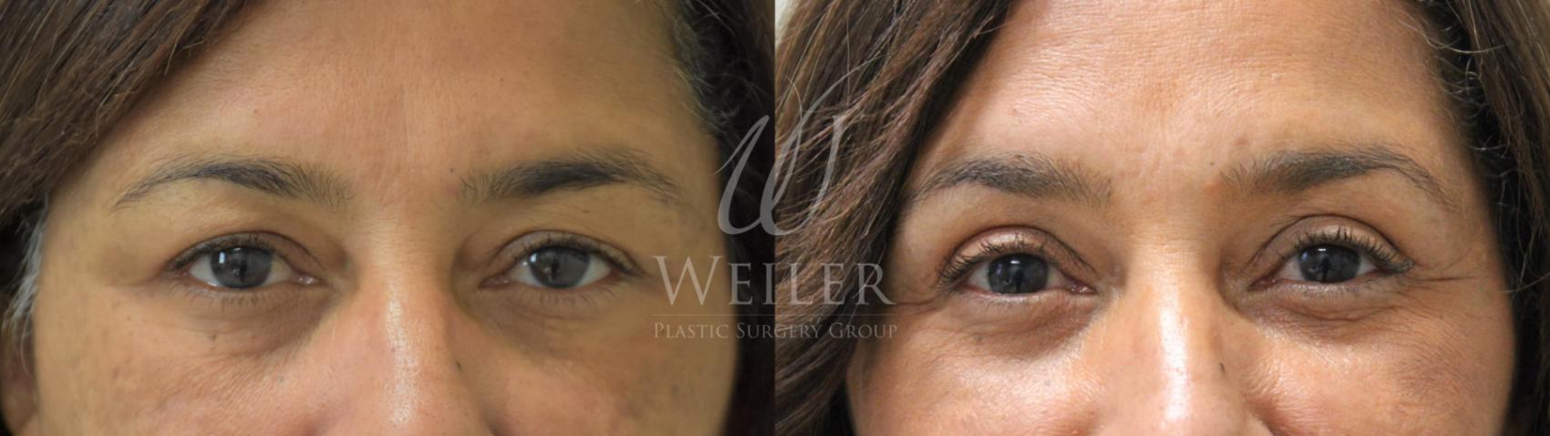 Before & After Eyelid Surgery Case 484 Front View in Baton Rouge, Louisiana