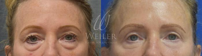 Before & After Eyelid Surgery Case 486 Front View in Baton Rouge, New Orleans, & Lafayette, Louisiana