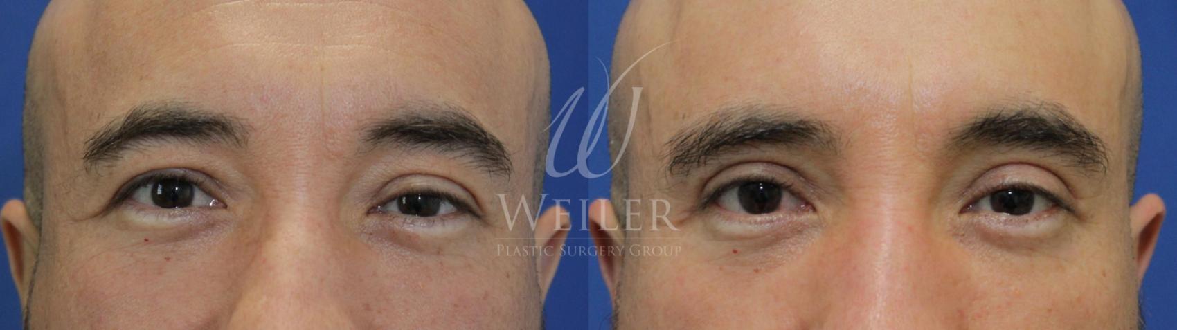 Before & After Eyelid Surgery Case 539 Front View in Baton Rouge, Louisiana