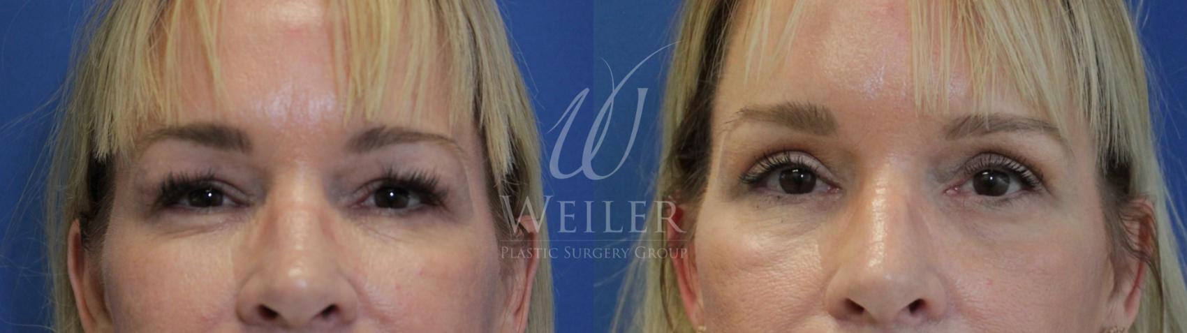 Before & After Eyelid Surgery Case 553 Front View in Baton Rouge, Louisiana
