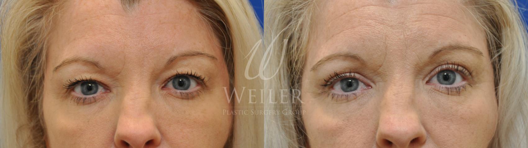 Before & After Eyelid Surgery Case 597 Front View in Baton Rouge, Louisiana