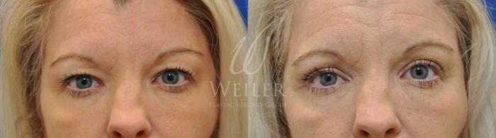 Before & After Eyelid Surgery Case 597 Front View in Baton Rouge, New Orleans, & Lafayette, Louisiana