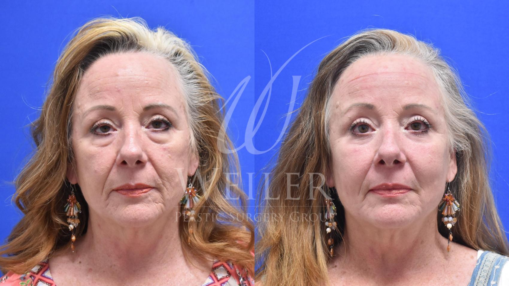 Before & After Eyelid Surgery Case 629 Front View in Baton Rouge, Louisiana