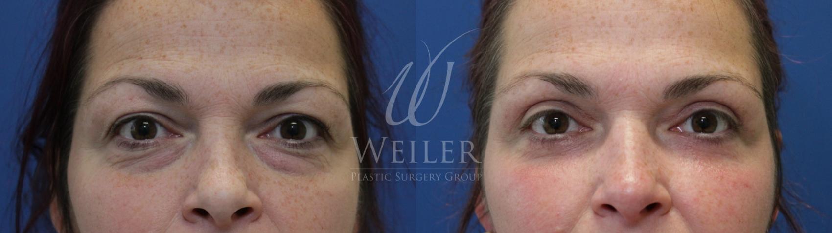 Before & After Eyelid Surgery Case 743 Front View in Baton Rouge, Louisiana