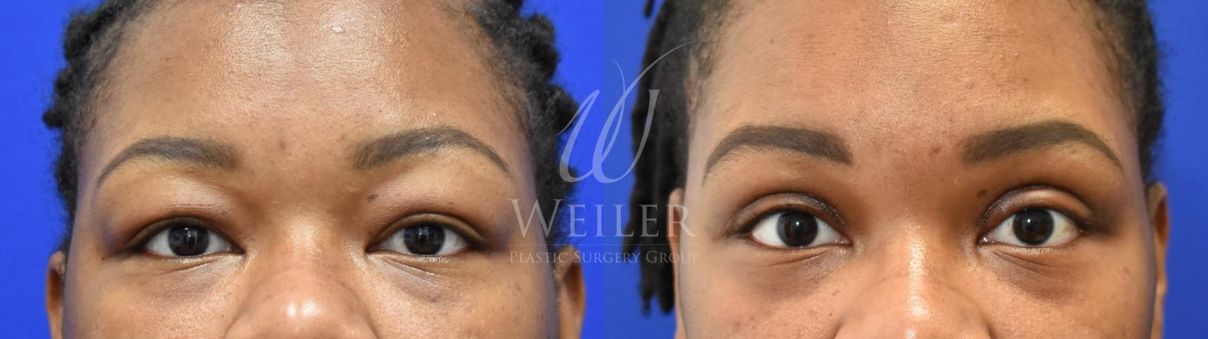 Before & After Eyelid Surgery Case 833 Front View in Baton Rouge, Louisiana