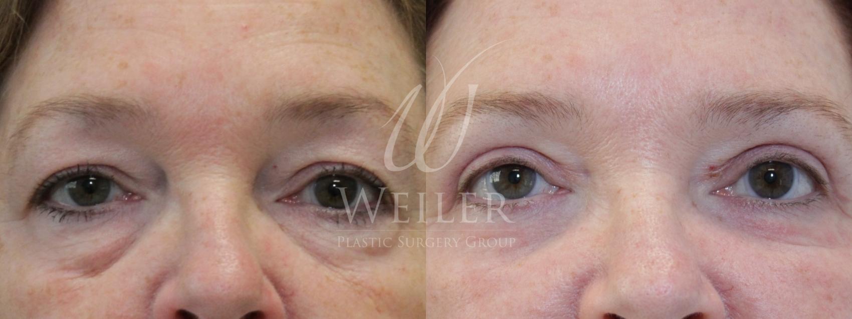 Before & After Eyelid Surgery Case 843 Front View in Baton Rouge, Louisiana