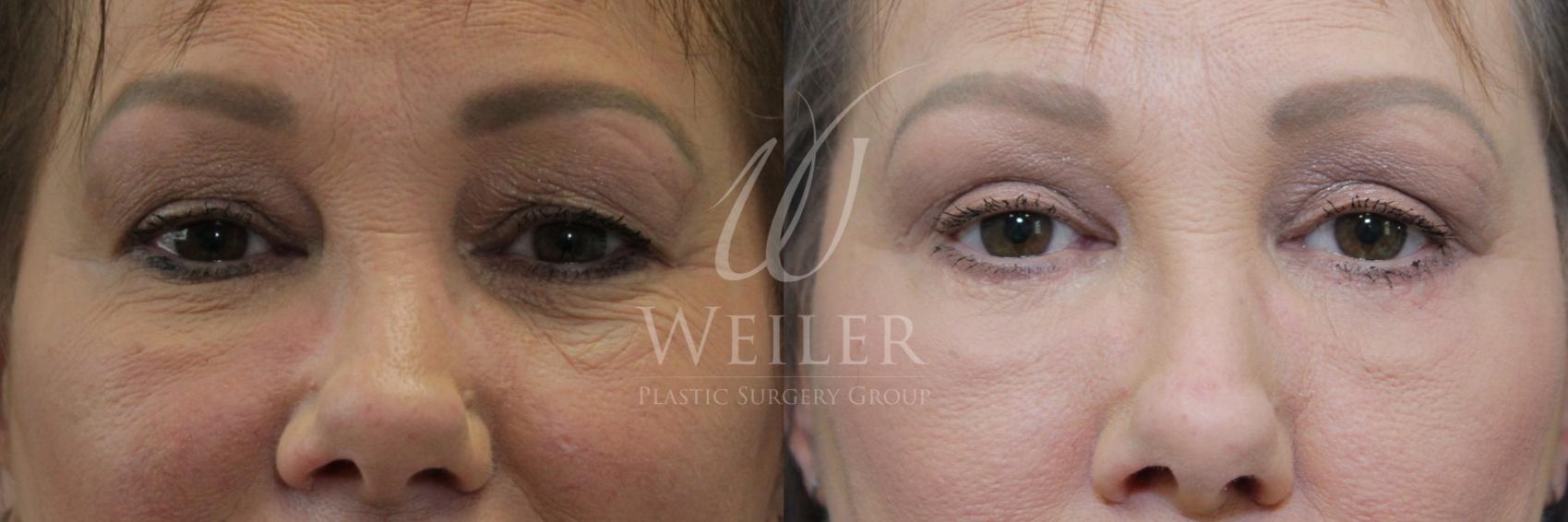 Before & After Eyelid Surgery Case 860 Front View in Baton Rouge, New Orleans, & Lafayette, Louisiana