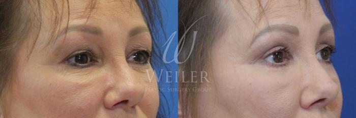 Before & After Eyelid Surgery Case 860 Right Oblique View in Baton Rouge, New Orleans, & Lafayette, Louisiana