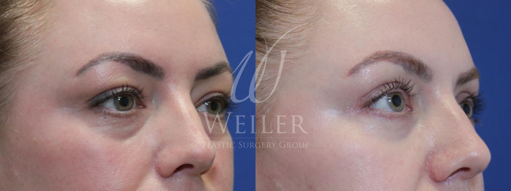 Before & After Eyelid Surgery Case 882 Right Oblique View in Baton Rouge, Louisiana