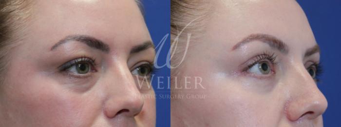 Before & After Eyelid Surgery Case 882 Right Oblique View in Baton Rouge, New Orleans, & Lafayette, Louisiana