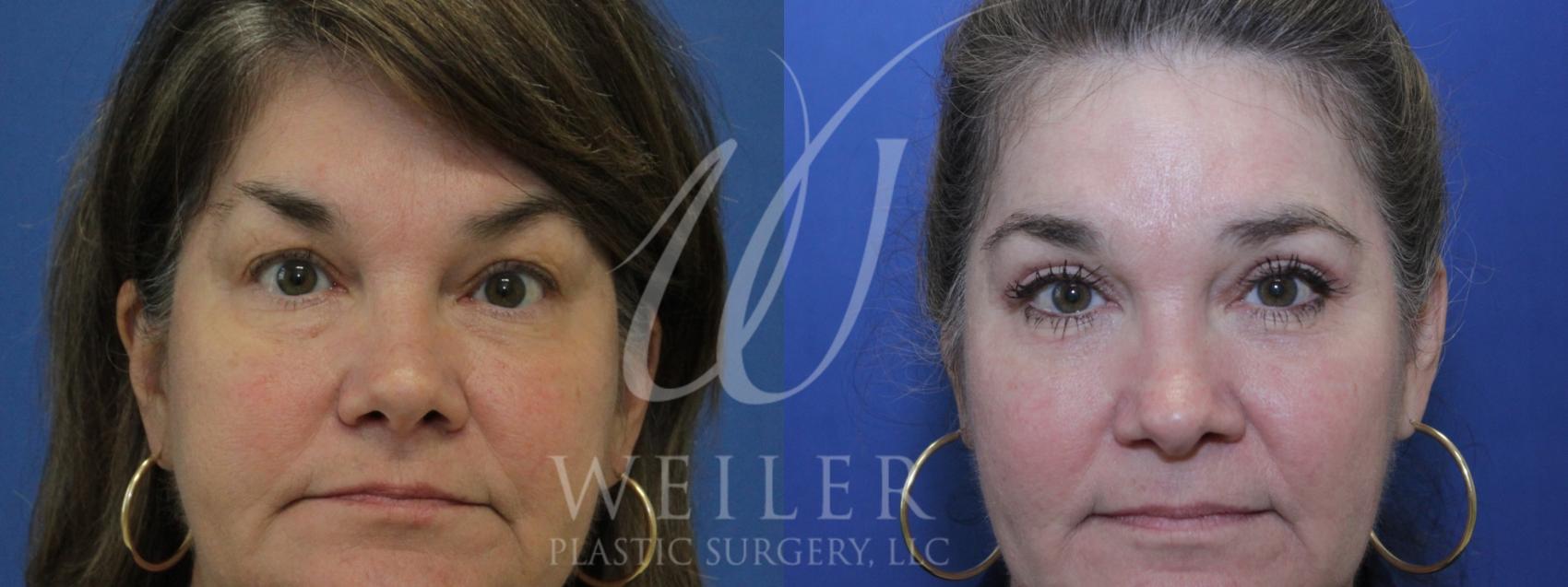 Before & After Eyelid Surgery Case 908 Front View in Baton Rouge, New Orleans, & Lafayette, Louisiana