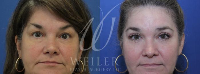 Before & After Eyelid Surgery Case 908 Front View in Baton Rouge, Louisiana