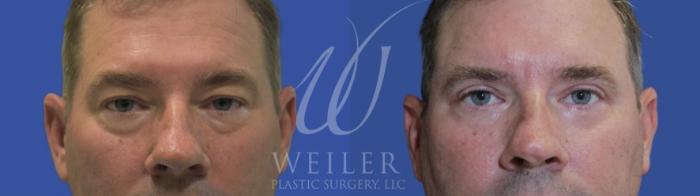 Before & After Eyelid Surgery Case 910 Front View in Baton Rouge, Louisiana