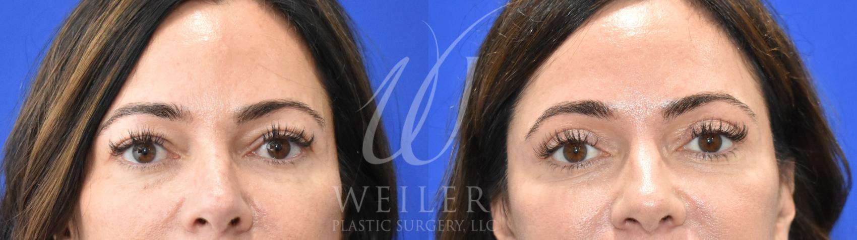Before & After Eyelid Surgery Case 943 Front View in Baton Rouge, Louisiana