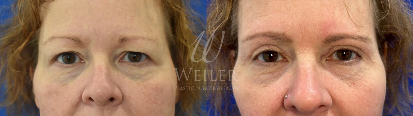 Before & After Eyelid Surgery Case 969 Front View in Baton Rouge, Louisiana