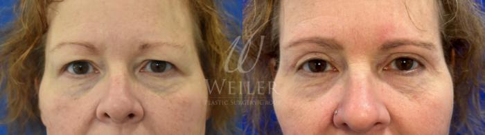 Before & After Eyelid Surgery Case 969 Front View in Baton Rouge, Louisiana