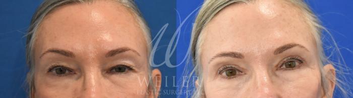 Before & After Eyelid Surgery Case 975 Front View in Baton Rouge, New Orleans, & Lafayette, Louisiana