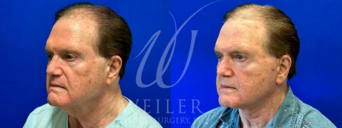 Before & After Facelift Case 1009 Left Oblique View in Baton Rouge, Louisiana
