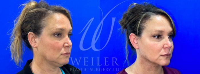 Before & After Facelift Case 1018 Right Oblique View in Baton Rouge, Louisiana