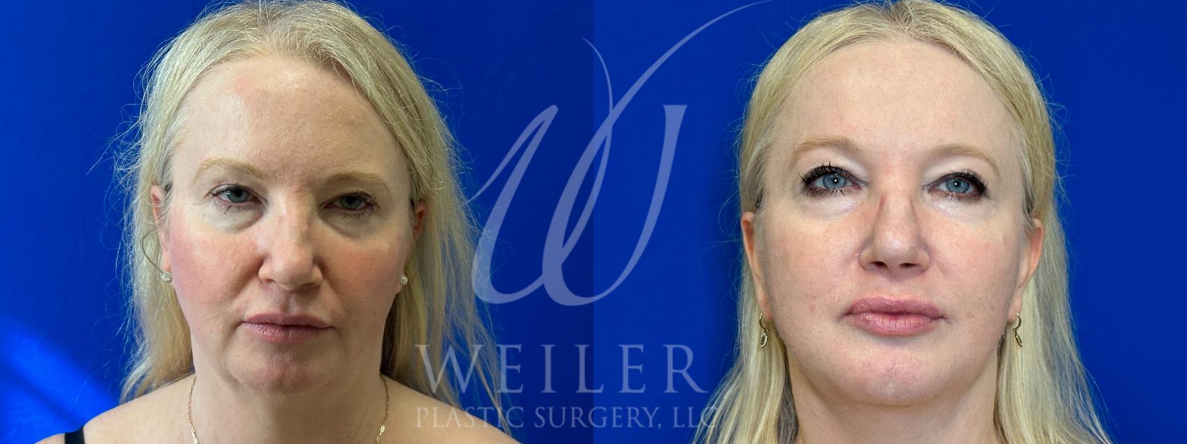 Before & After Facelift Case 1044 Front View in Baton Rouge, New Orleans, & Lafayette, Louisiana