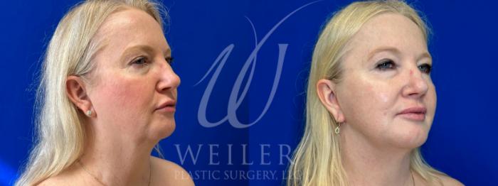Before & After Facelift Case 1044 Right Oblique View in Baton Rouge, New Orleans, & Lafayette, Louisiana