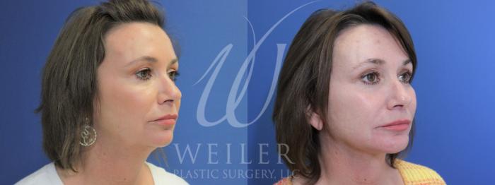 Before & After Facelift Case 1059 Right Oblique View in Baton Rouge, Louisiana