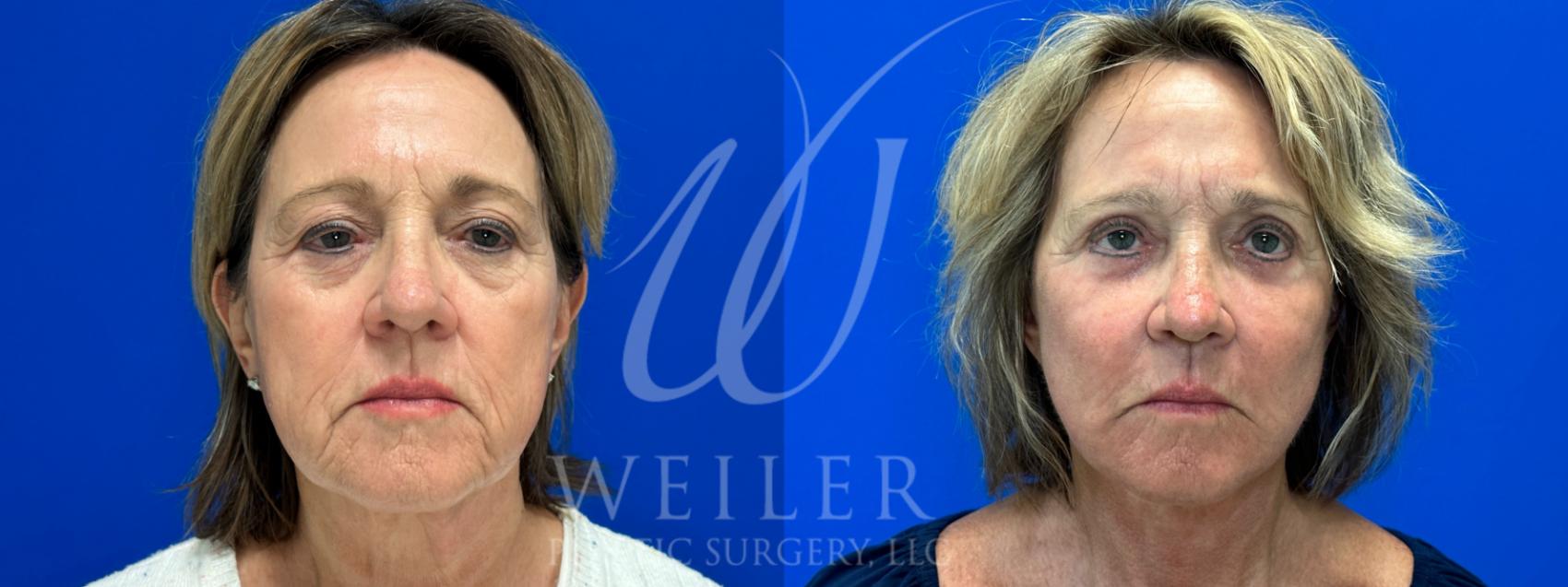 Before & After Facelift Case 1060 Front View in Baton Rouge, Louisiana