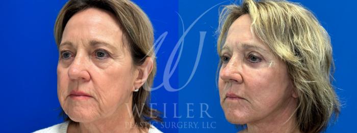 Before & After Facelift Case 1060 Left Oblique View in Baton Rouge, Louisiana