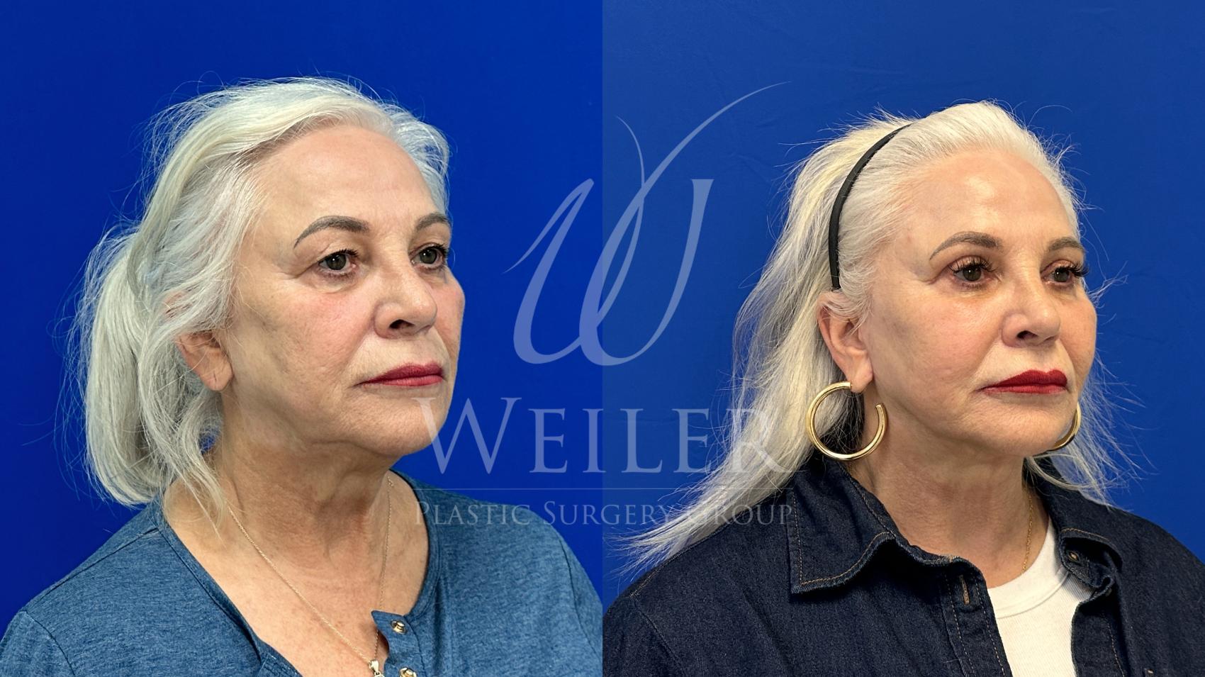 Before & After Eyelid Surgery Case 1536 Right Oblique View in Baton Rouge, New Orleans, & Lafayette, Louisiana