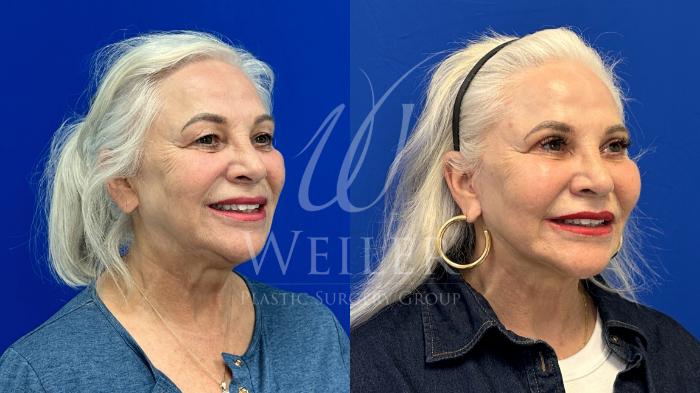 Before & After Eyelid Surgery Case 1536 Right Side View in Baton Rouge, New Orleans, & Lafayette, Louisiana