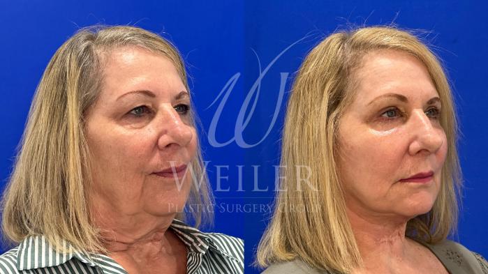 Before & After Facelift Case 1655 Right Oblique View in Baton Rouge, New Orleans, & Lafayette, Louisiana