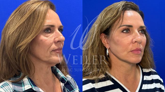 【THE FACE 】No.98 Facelift Before and After Pictures Case 1656 | Baton Rouge, New