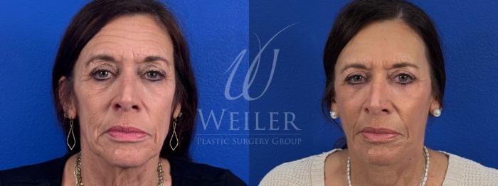 Before & After Eyelid Surgery Case 1672 Front View in Baton Rouge, New Orleans, & Lafayette, Louisiana