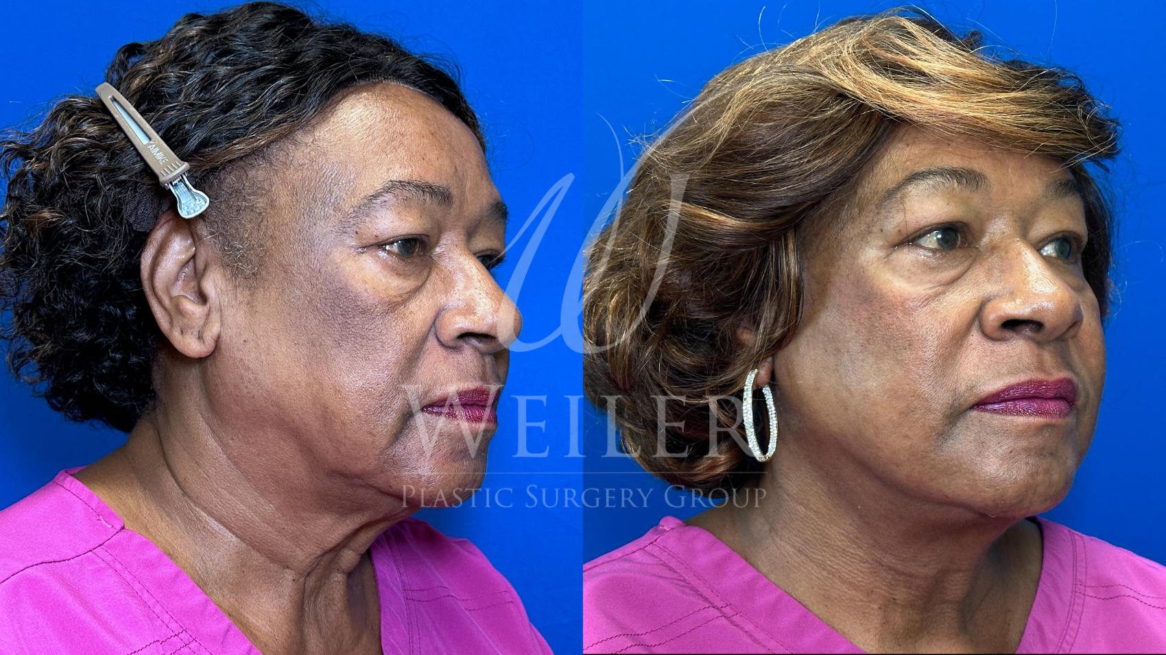 Before & After Facelift Case 1700 Right Oblique View in Baton Rouge, New Orleans, & Lafayette, Louisiana