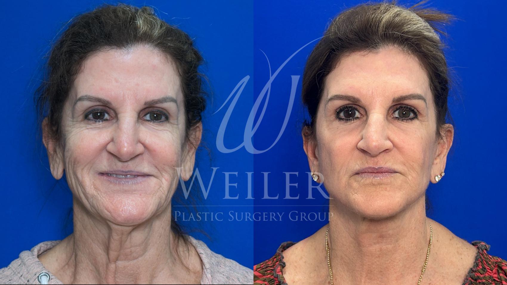 Before & After Facelift Case 1701 Front View in Baton Rouge, New Orleans, & Lafayette, Louisiana