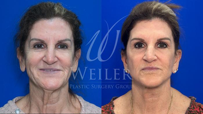 Before & After Facelift Case 1701 Front View in Baton Rouge, New Orleans, & Lafayette, Louisiana