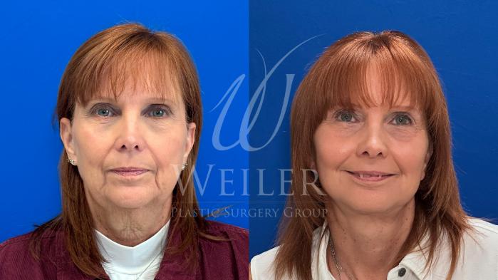 Before & After Facelift Case 1702 Front View in Baton Rouge, New Orleans, & Lafayette, Louisiana