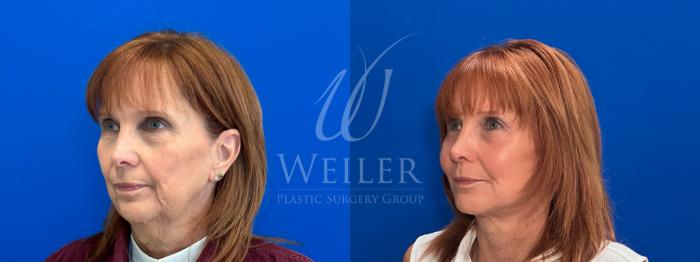 Before & After Facelift Case 1702 Left Oblique View in Baton Rouge, New Orleans, & Lafayette, Louisiana