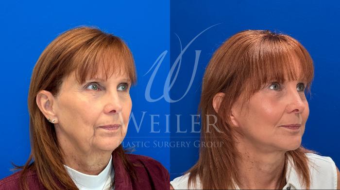 Before & After Facelift Case 1702 Right Oblique View in Baton Rouge, New Orleans, & Lafayette, Louisiana