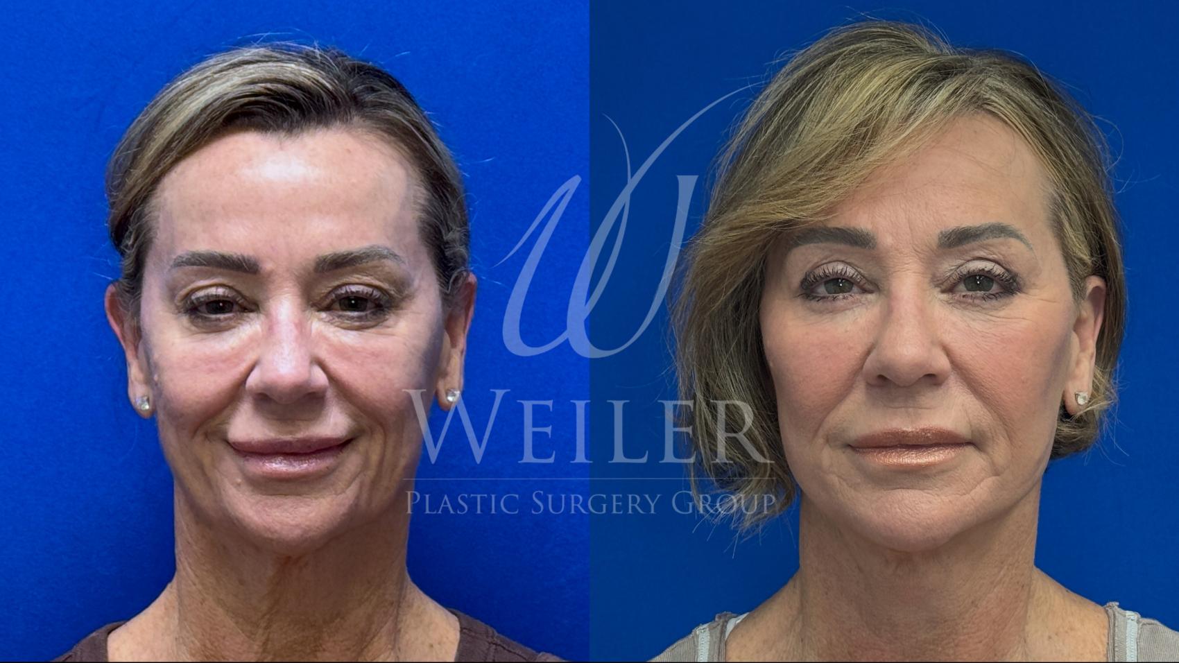 Before & After Facelift Case 1704 Front View in Baton Rouge, New Orleans, & Lafayette, Louisiana