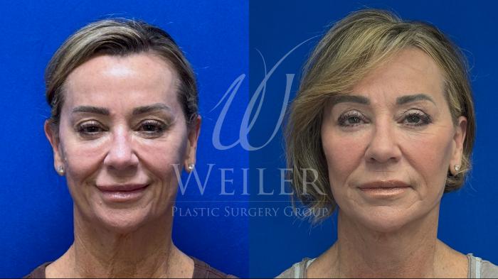 Before & After Facelift Case 1704 Front View in Baton Rouge, New Orleans, & Lafayette, Louisiana