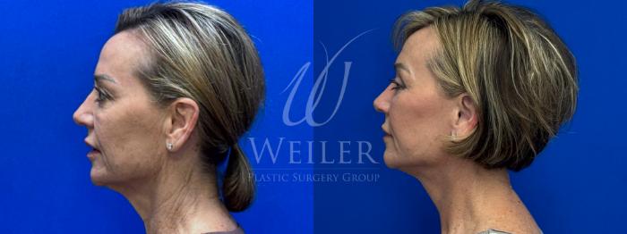 Before & After Facelift Case 1704 Left Side View in Baton Rouge, New Orleans, & Lafayette, Louisiana
