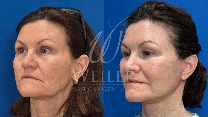 Before & After Facelift Case 1748 Left Oblique View in Baton Rouge, New Orleans, & Lafayette, Louisiana
