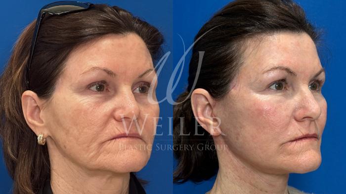 Before & After Facelift Case 1748 Right Oblique View in Baton Rouge, New Orleans, & Lafayette, Louisiana