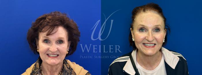 Before & After Facelift Case 1780 Front View in Baton Rouge, New Orleans, & Lafayette, Louisiana