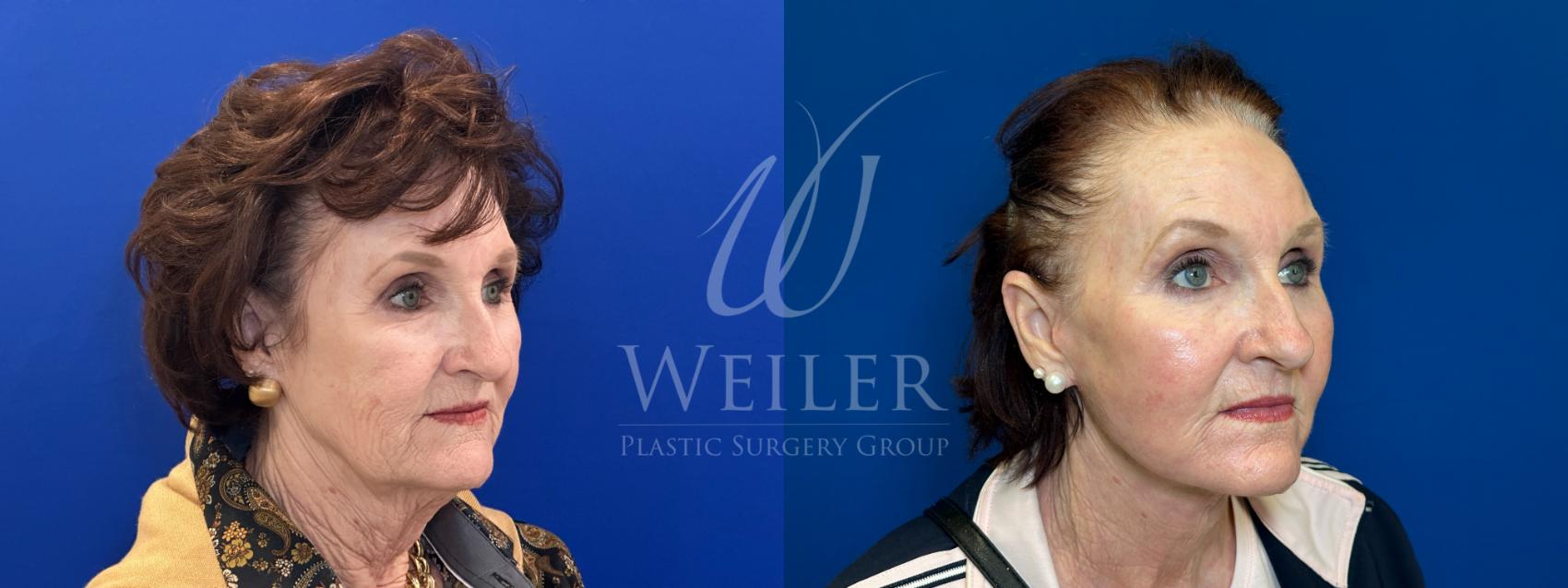 Before & After Facelift Case 1780 Right Oblique View in Baton Rouge, New Orleans, & Lafayette, Louisiana